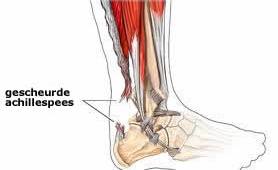 Richard in het&nbsp;gips